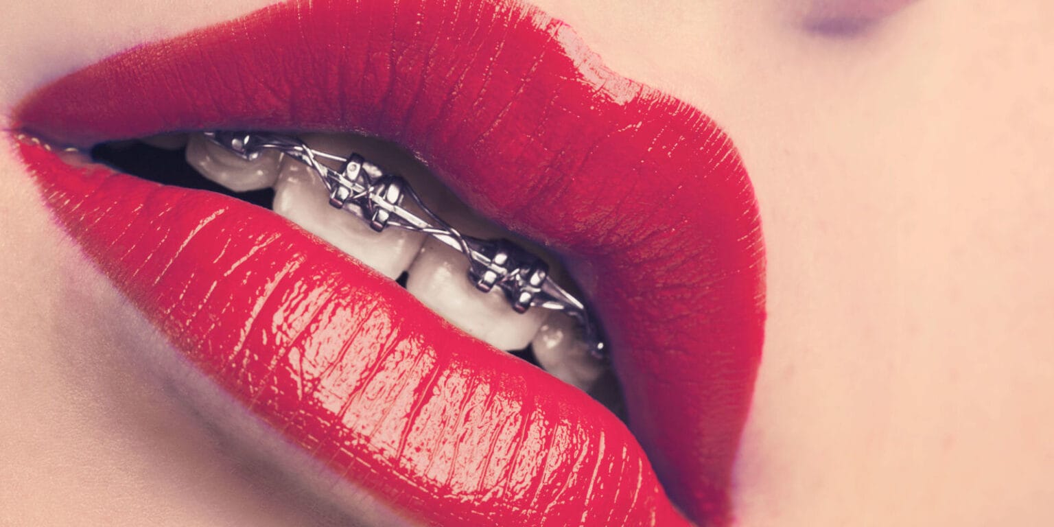 Is There a Age Limit for Braces?